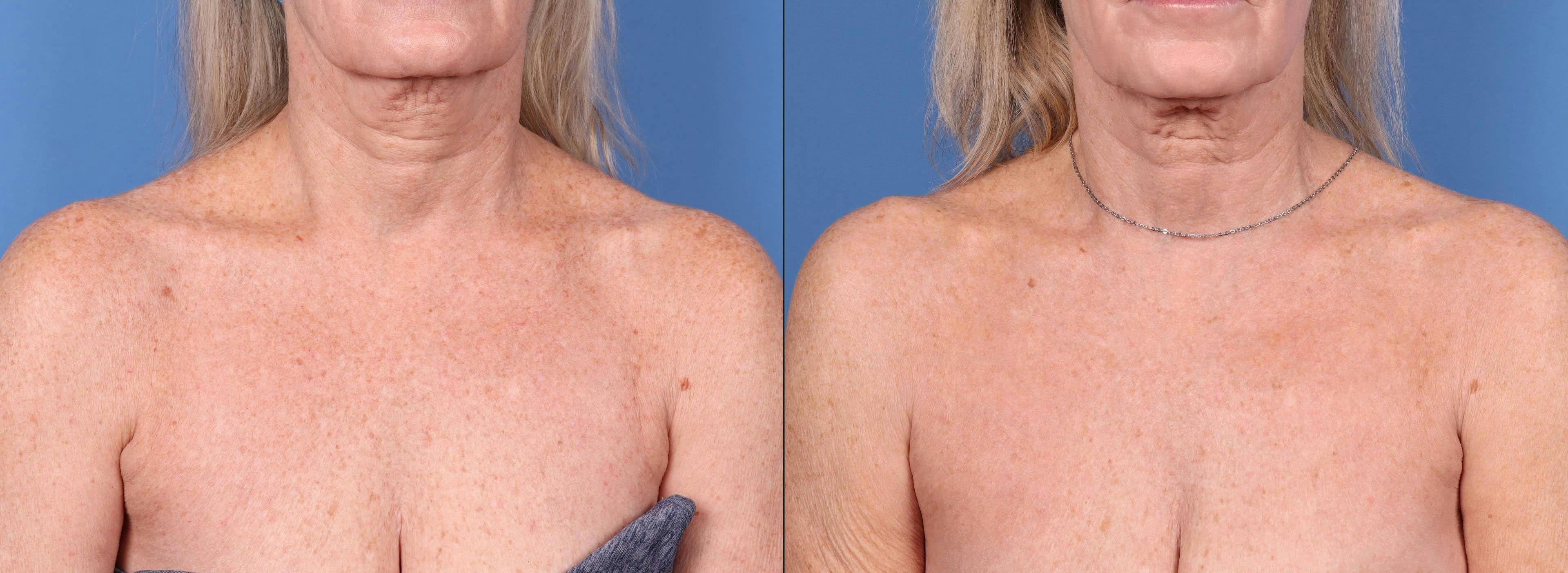 Contour TRL Laser Before & After Gallery - Patient 114701450 - Image 3