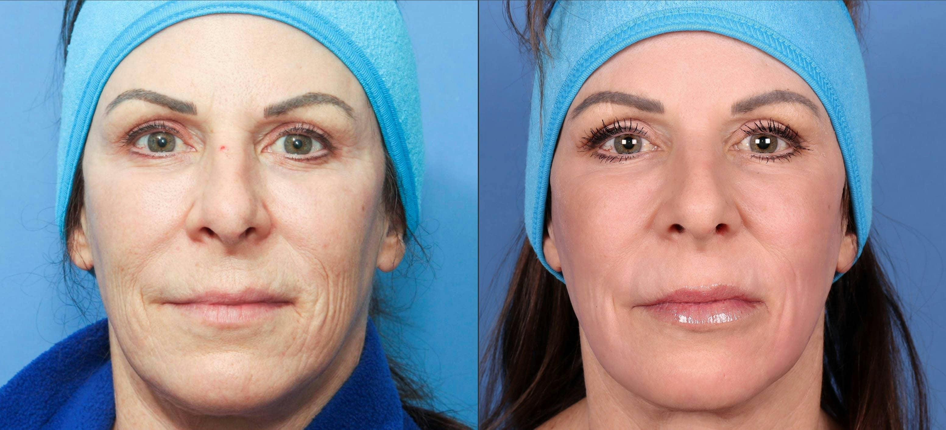 Contour TRL Laser Before & After Gallery - Patient 116698611 - Image 1