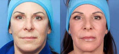 Contour TRL Laser Before & After Gallery - Patient 116698611 - Image 1