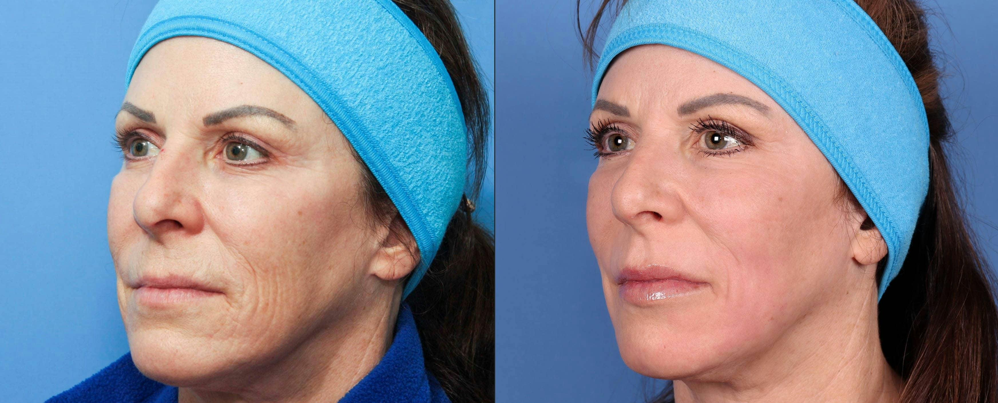Contour TRL Laser Before & After Gallery - Patient 116698611 - Image 2
