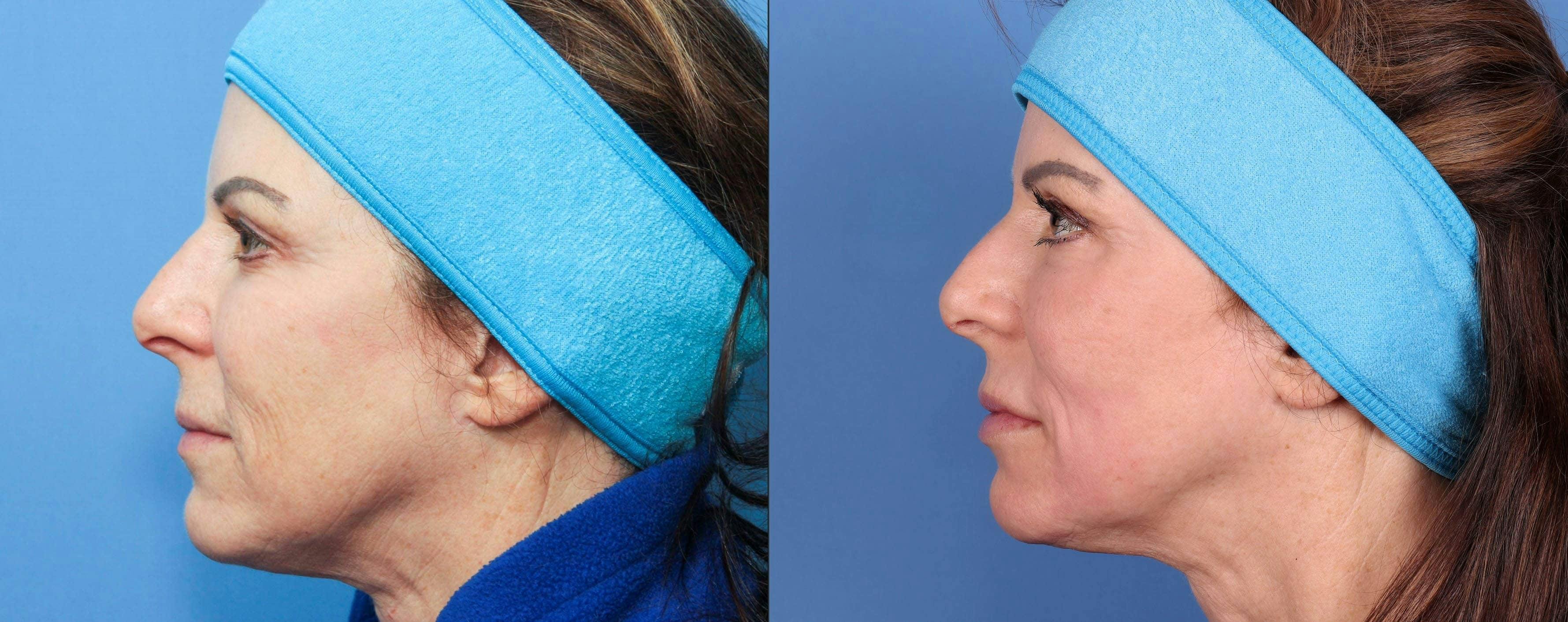 Contour TRL Laser Before & After Gallery - Patient 116698611 - Image 3