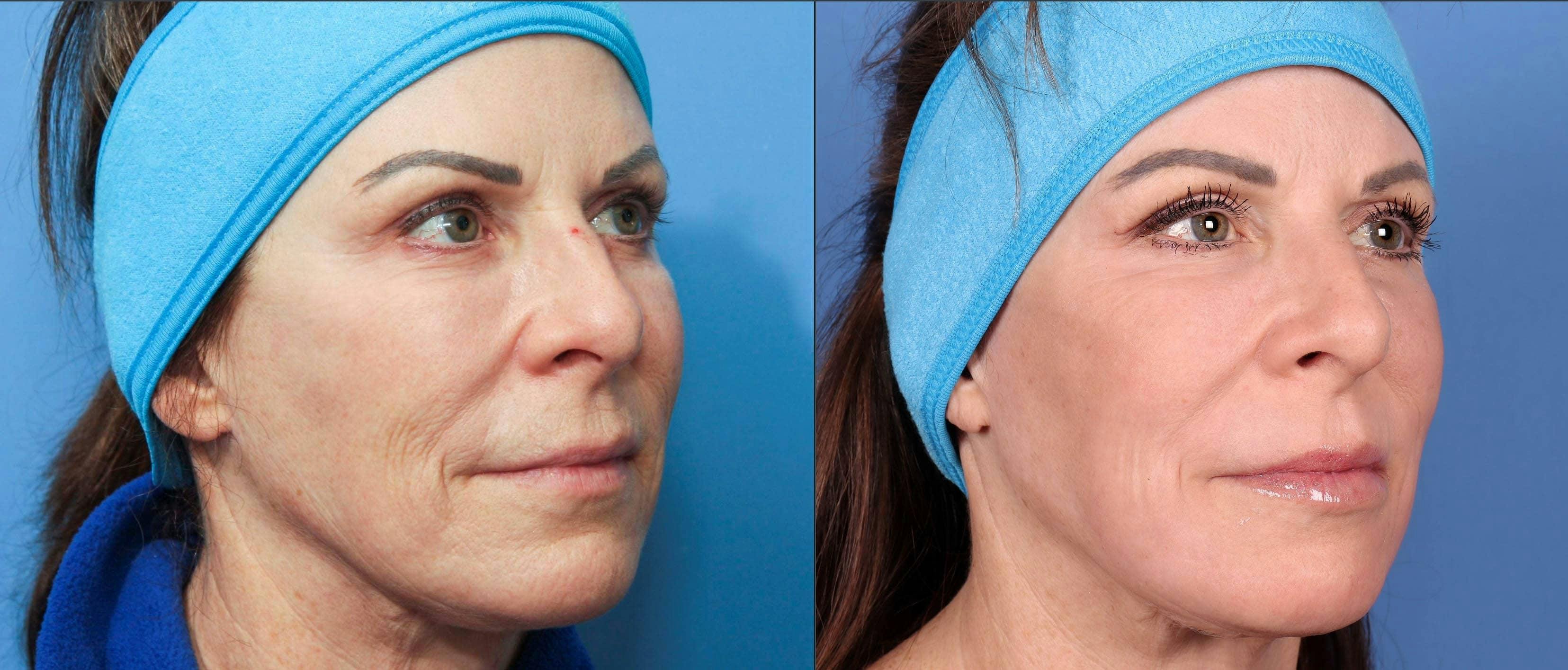 Contour TRL Laser Before & After Gallery - Patient 116698611 - Image 4