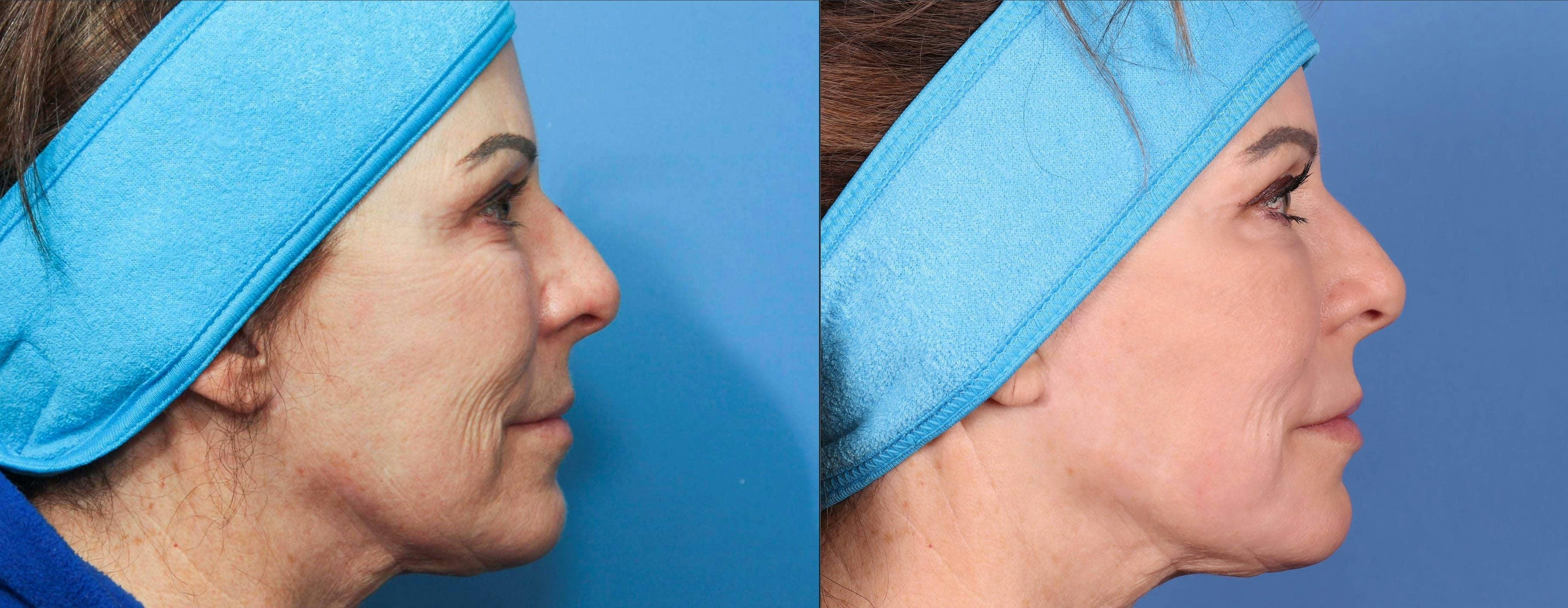 Contour TRL Laser Before & After Gallery - Patient 116698611 - Image 5