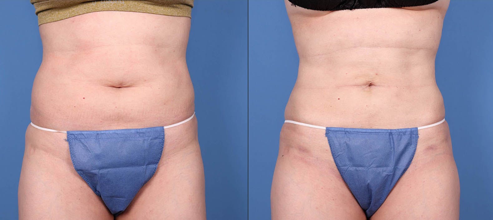 Liposuction Before & After Gallery - Patient 117602641 - Image 1