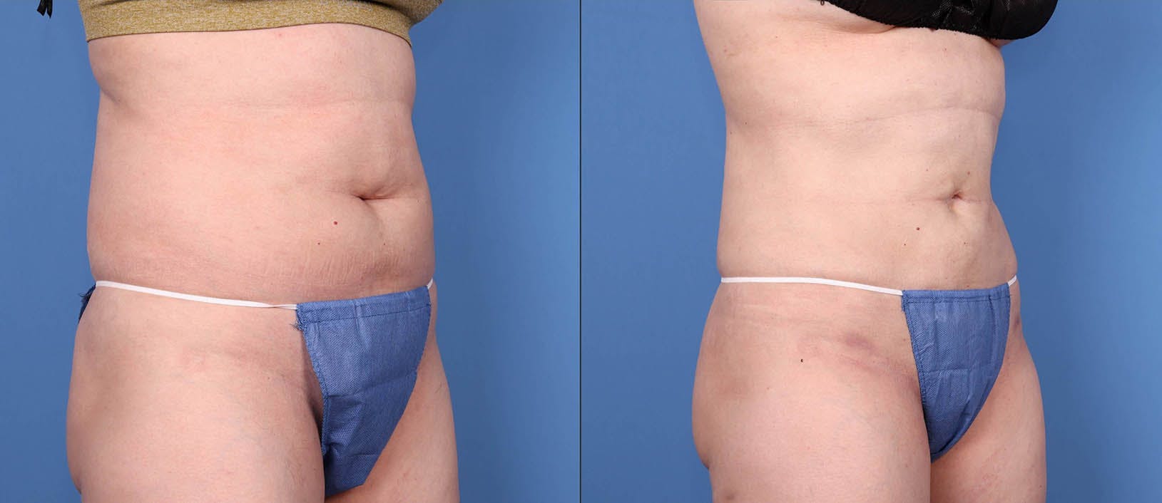 Abdomen Before & After Gallery - Patient 149385224 - Image 2