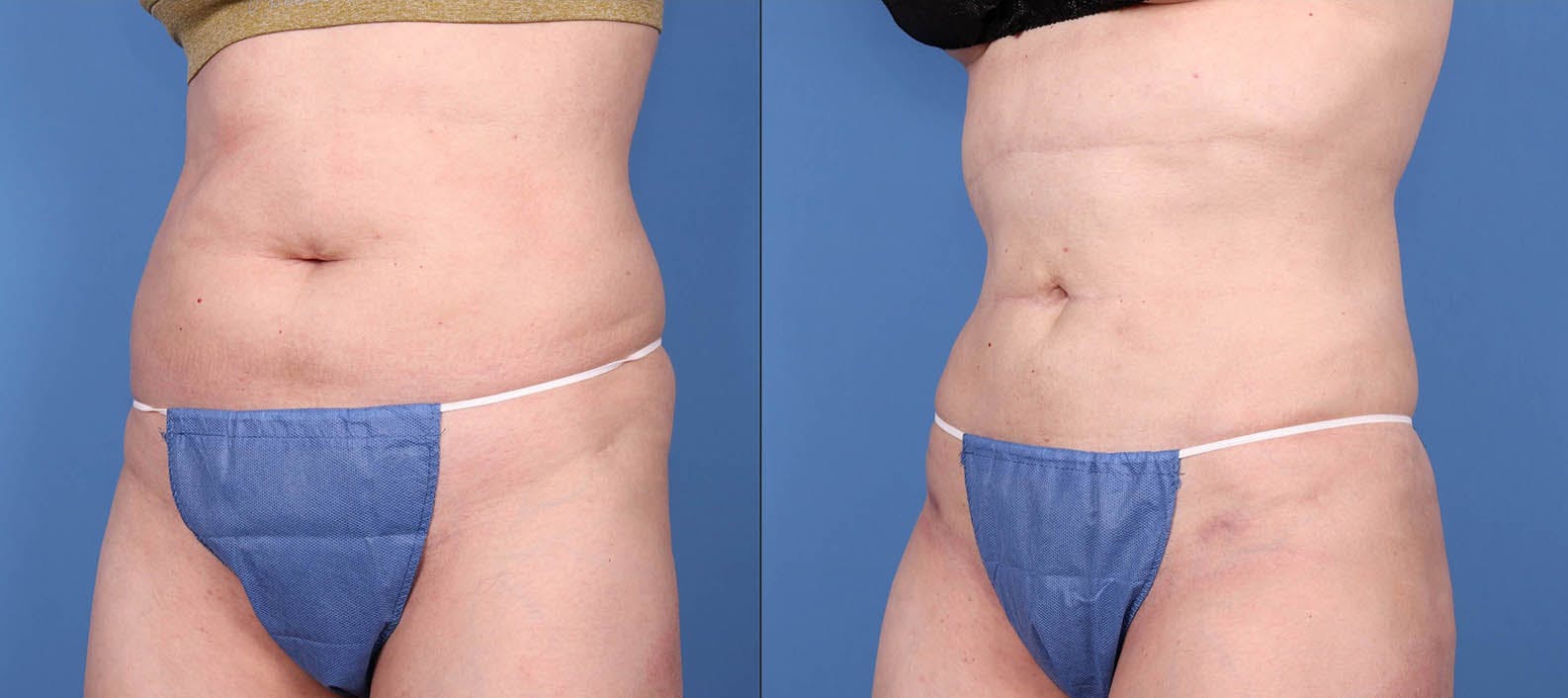 Abdomen Before & After Gallery - Patient 149385224 - Image 3