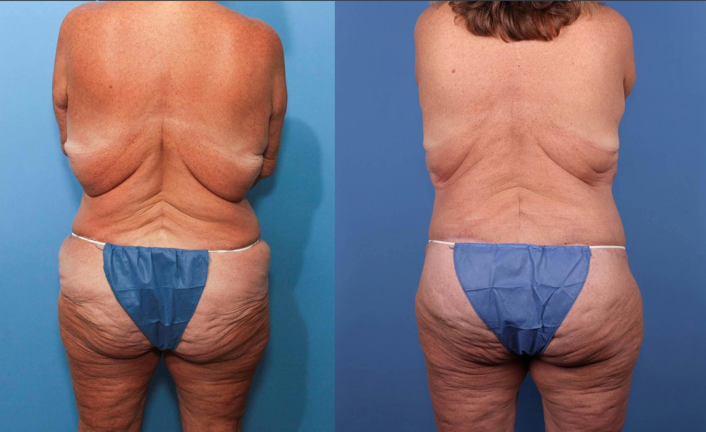 Hips Before & After Gallery - Patient 149385342 - Image 1