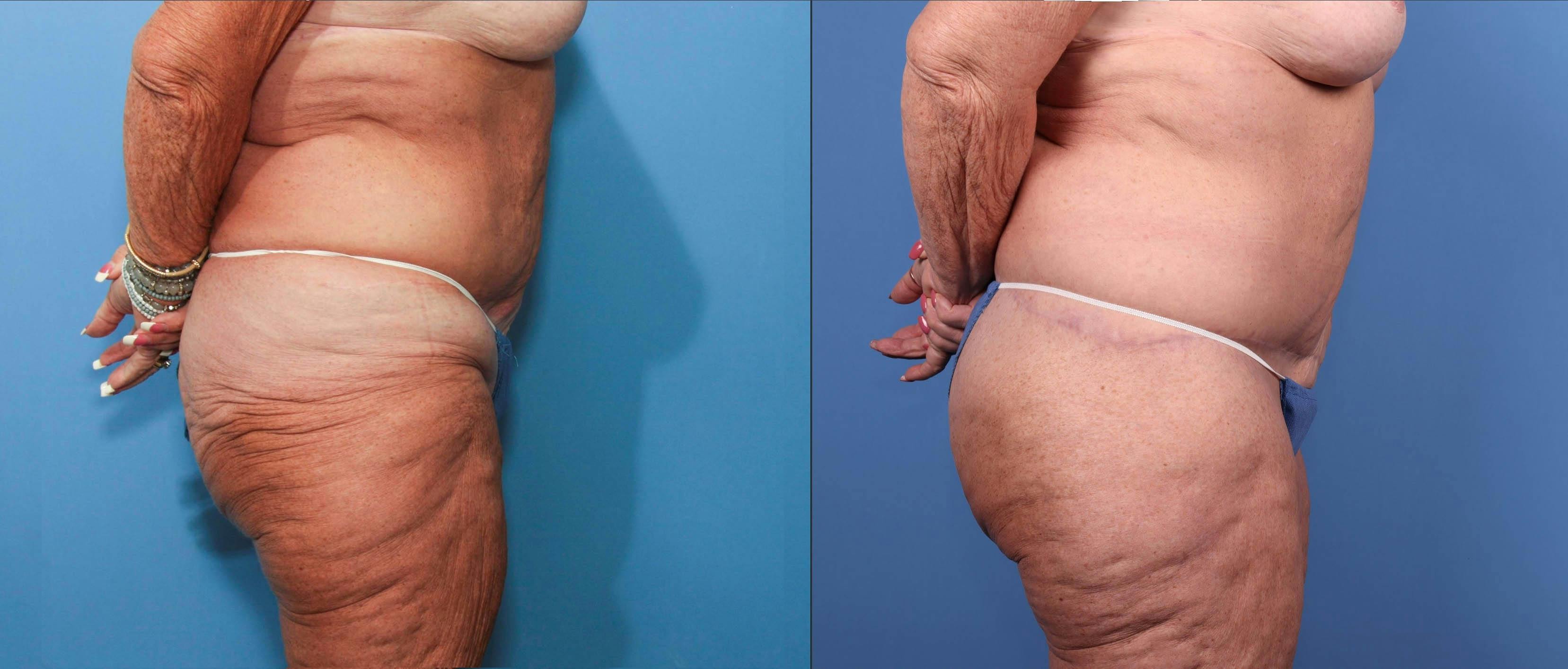 Liposuction Before & After Gallery - Patient 119522855 - Image 2