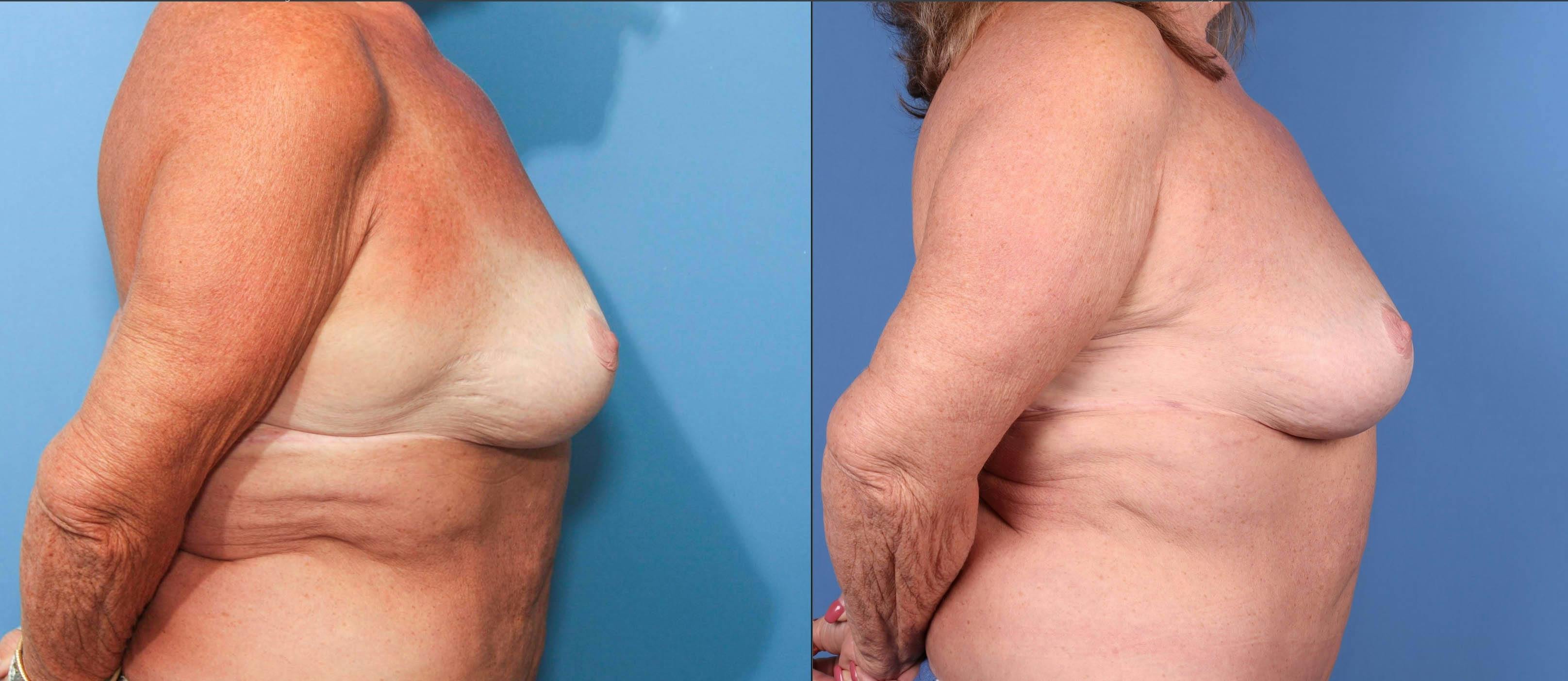 Hips Before & After Gallery - Patient 149385342 - Image 3
