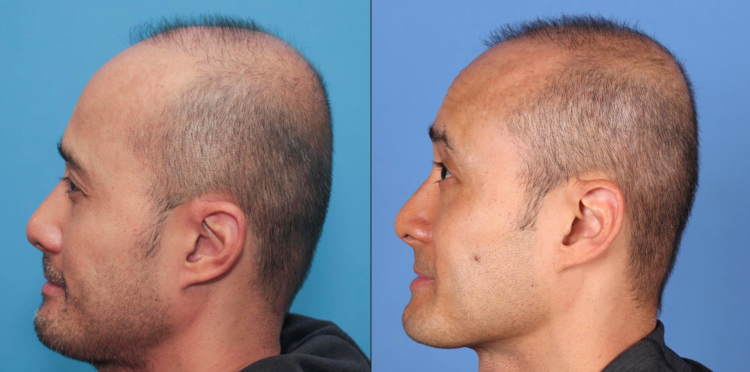 NeoGraft Hair Restoration Before & After Gallery - Patient 119927280 - Image 2