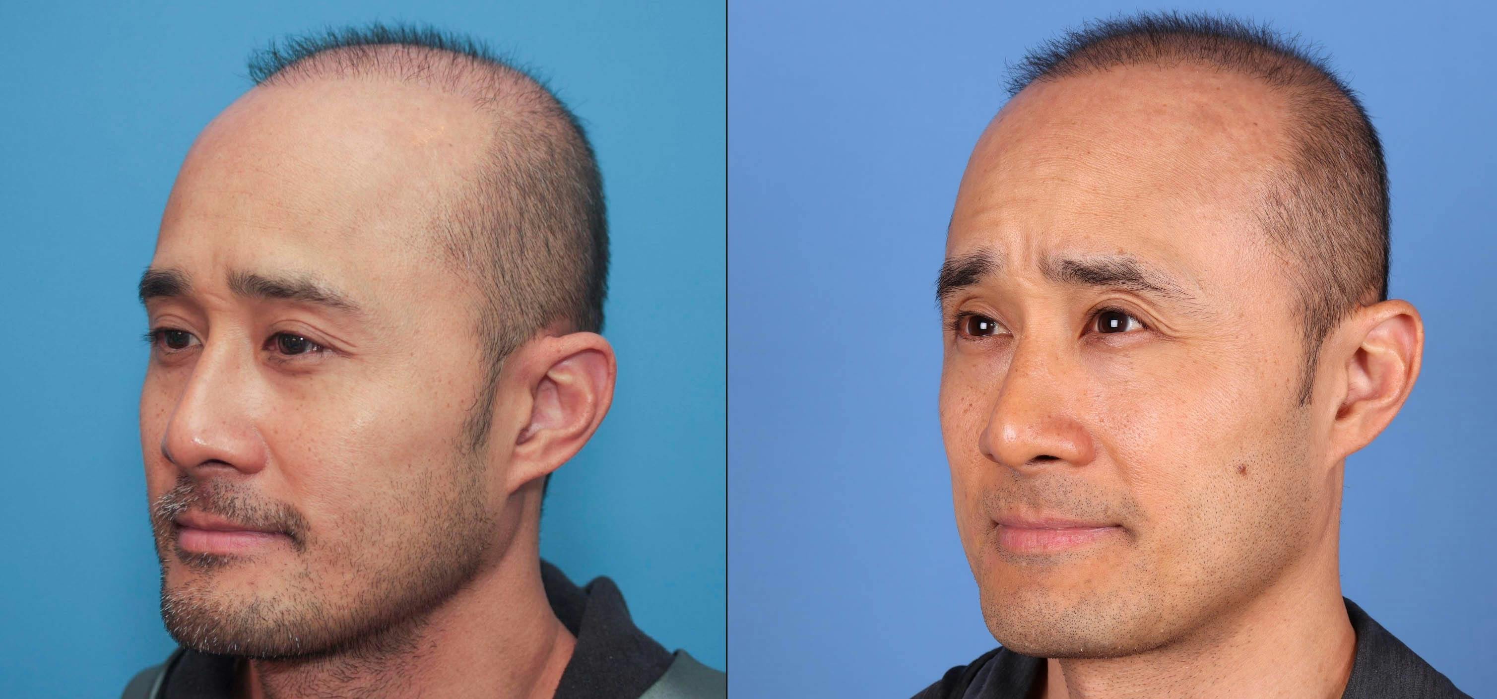 NeoGraft Hair Restoration Before & After Gallery - Patient 119927280 - Image 1
