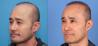 NeoGraft Hair Restoration Before & After Gallery - Patient 119927280 - Image 1