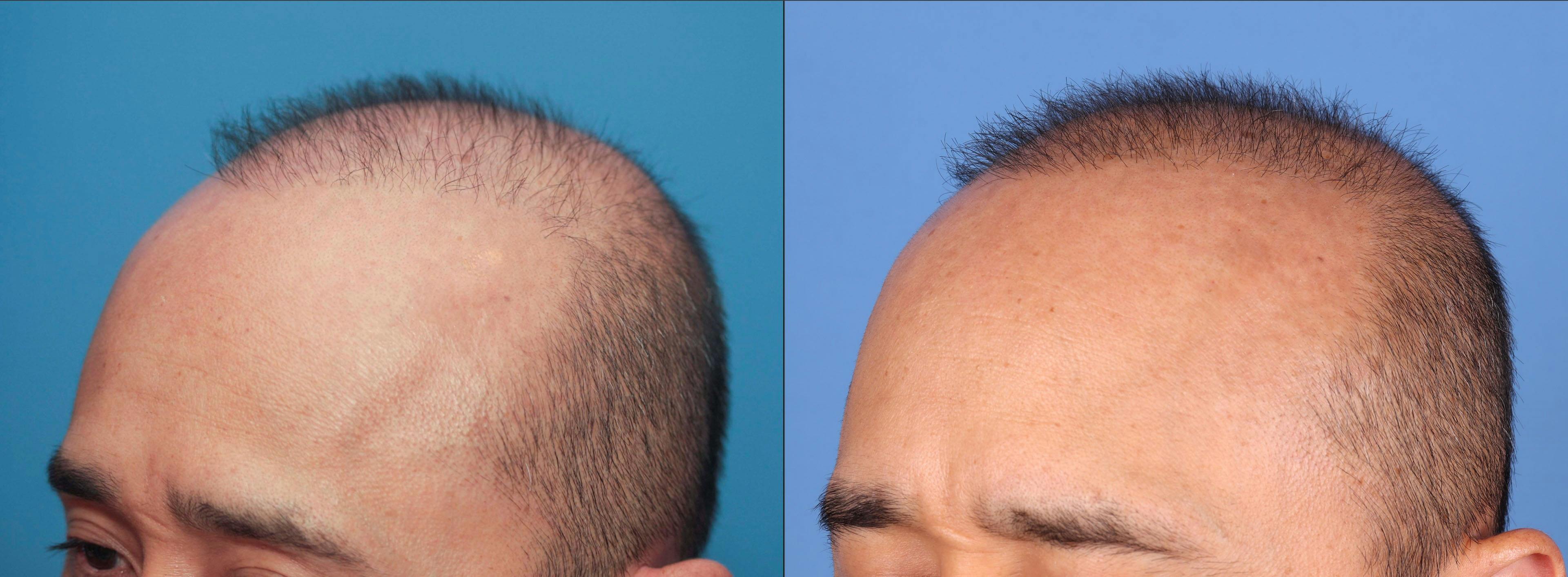 NeoGraft Hair Restoration Before & After Gallery - Patient 119927280 - Image 3