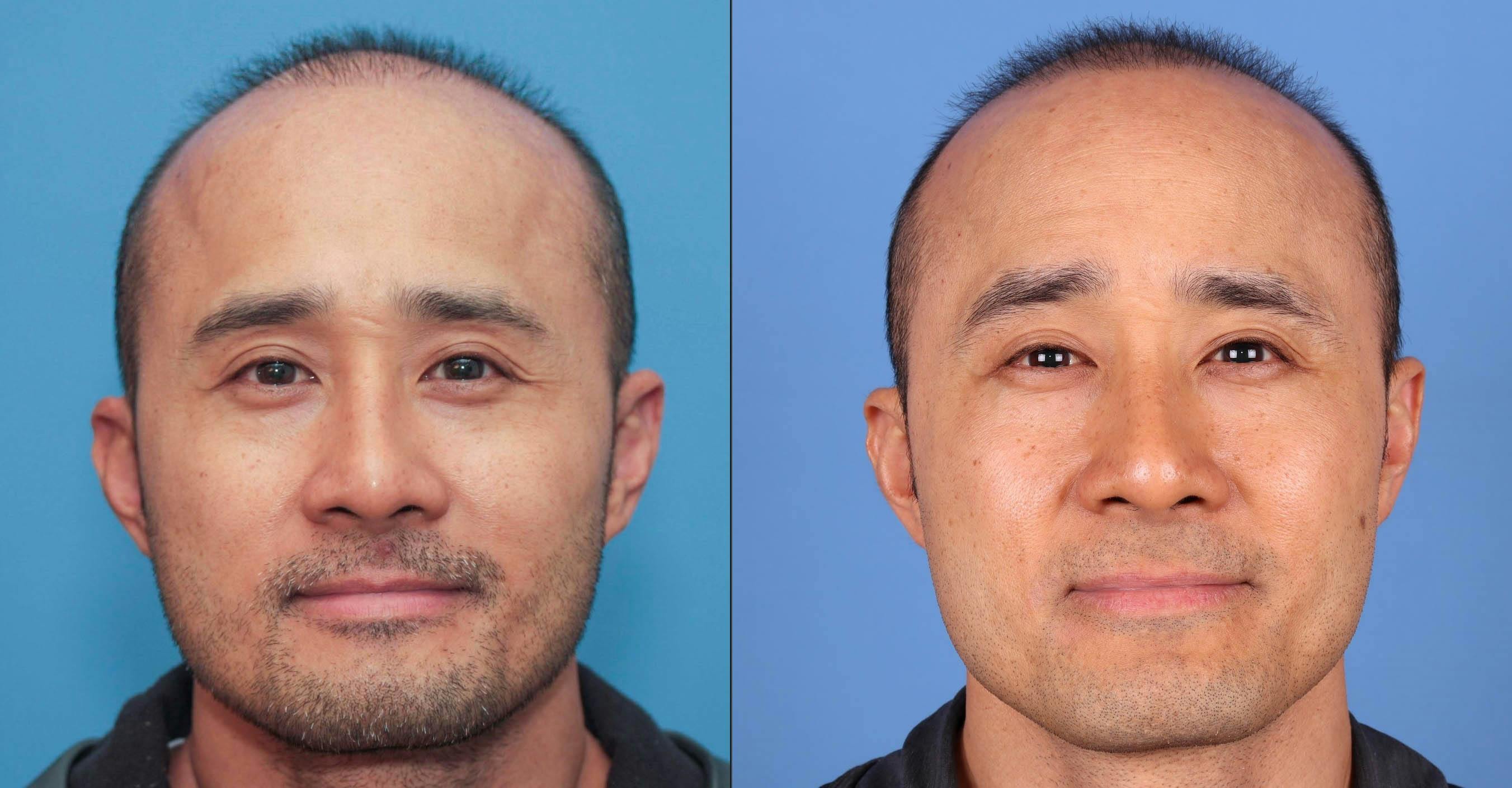 NeoGraft Hair Restoration Before & After Gallery - Patient 119927280 - Image 4