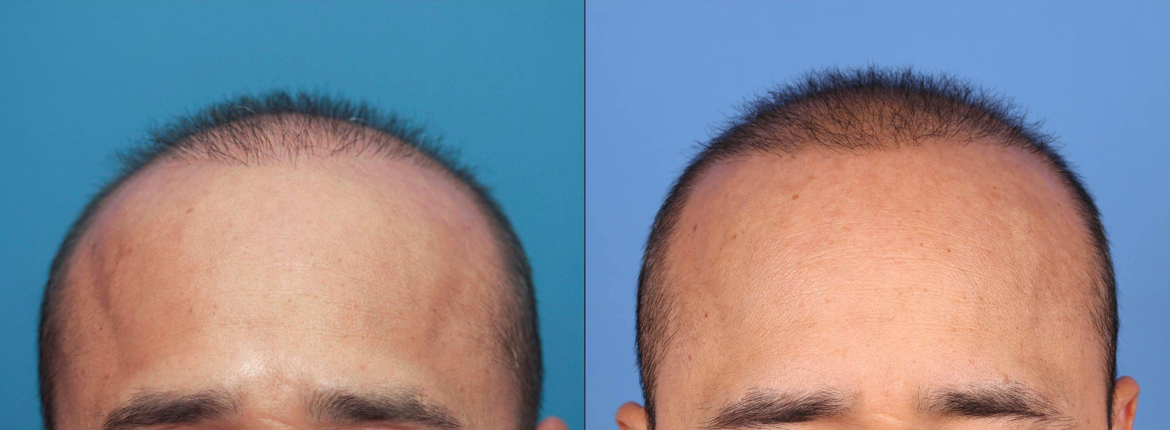 NeoGraft Hair Restoration Before & After Gallery - Patient 119927280 - Image 5