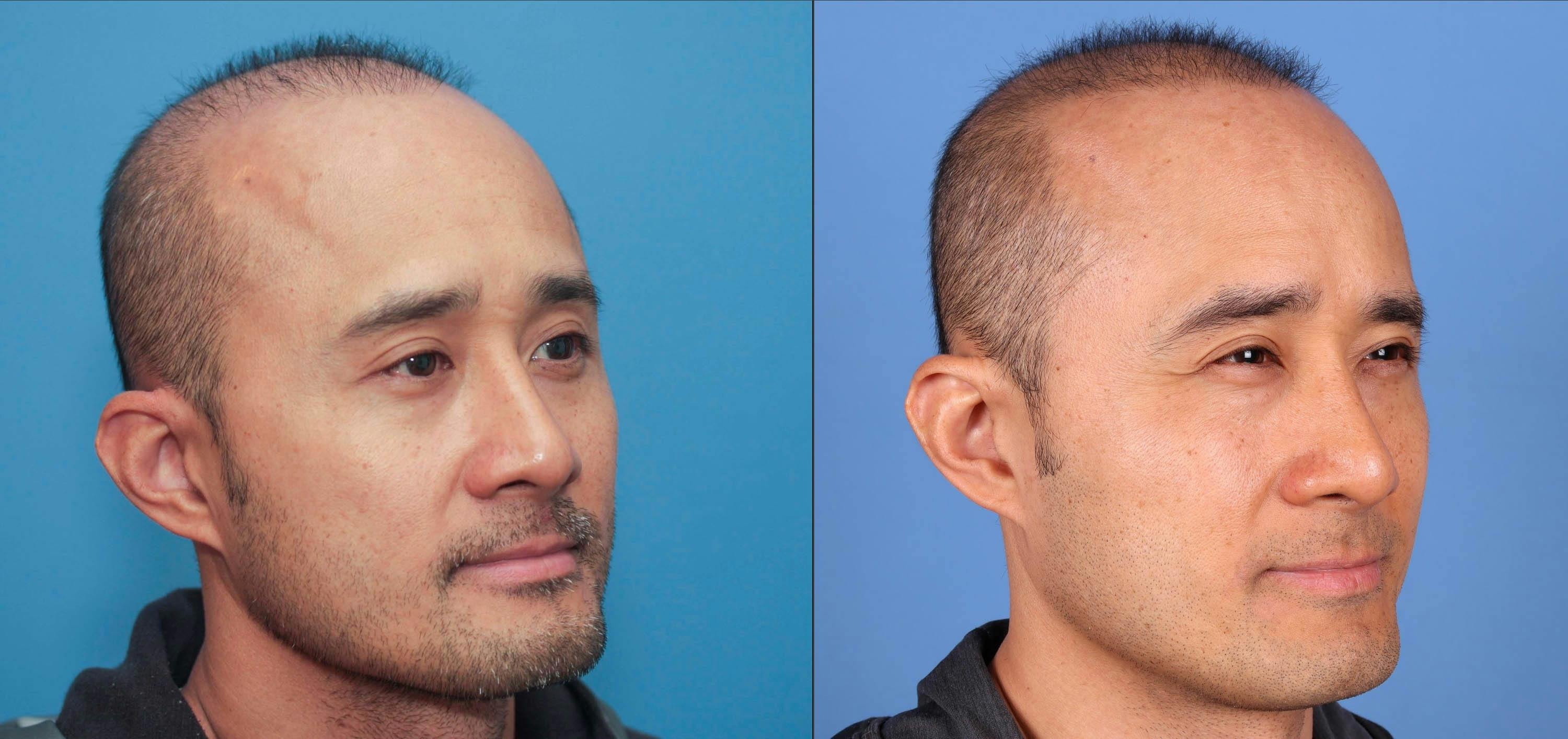 NeoGraft Hair Restoration Before & After Gallery - Patient 119927280 - Image 6