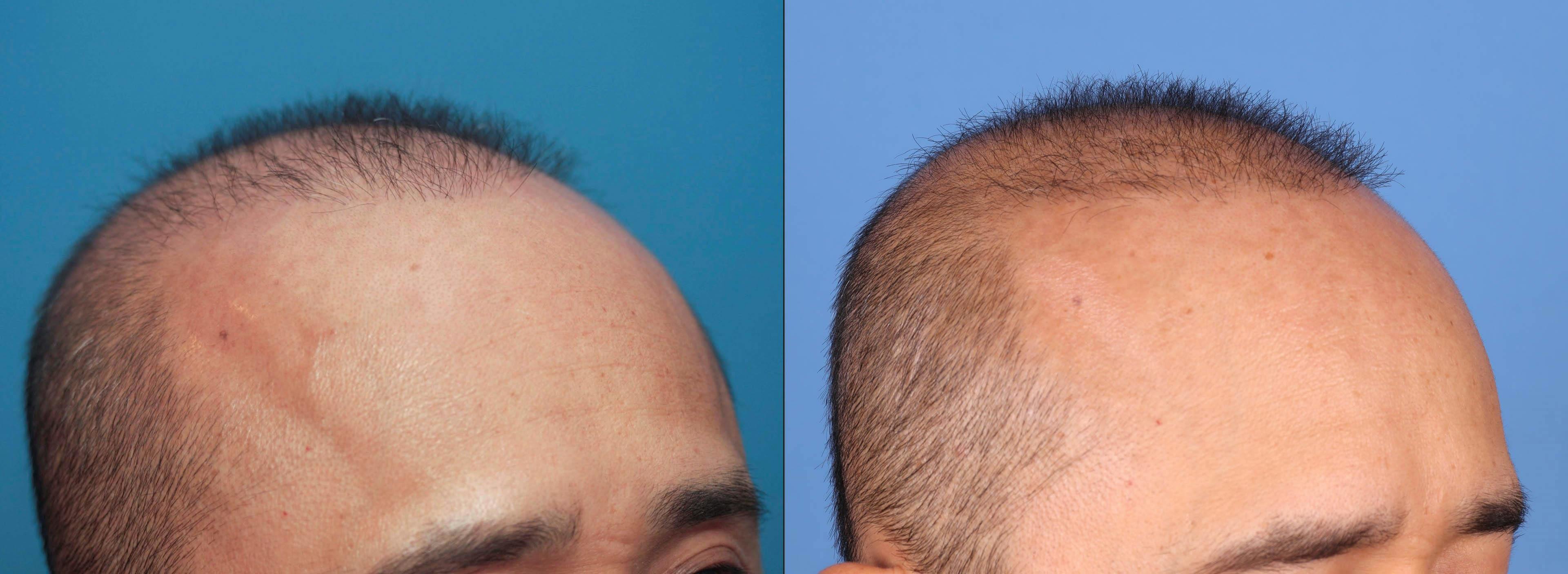 NeoGraft Hair Restoration Before & After Gallery - Patient 119927280 - Image 7