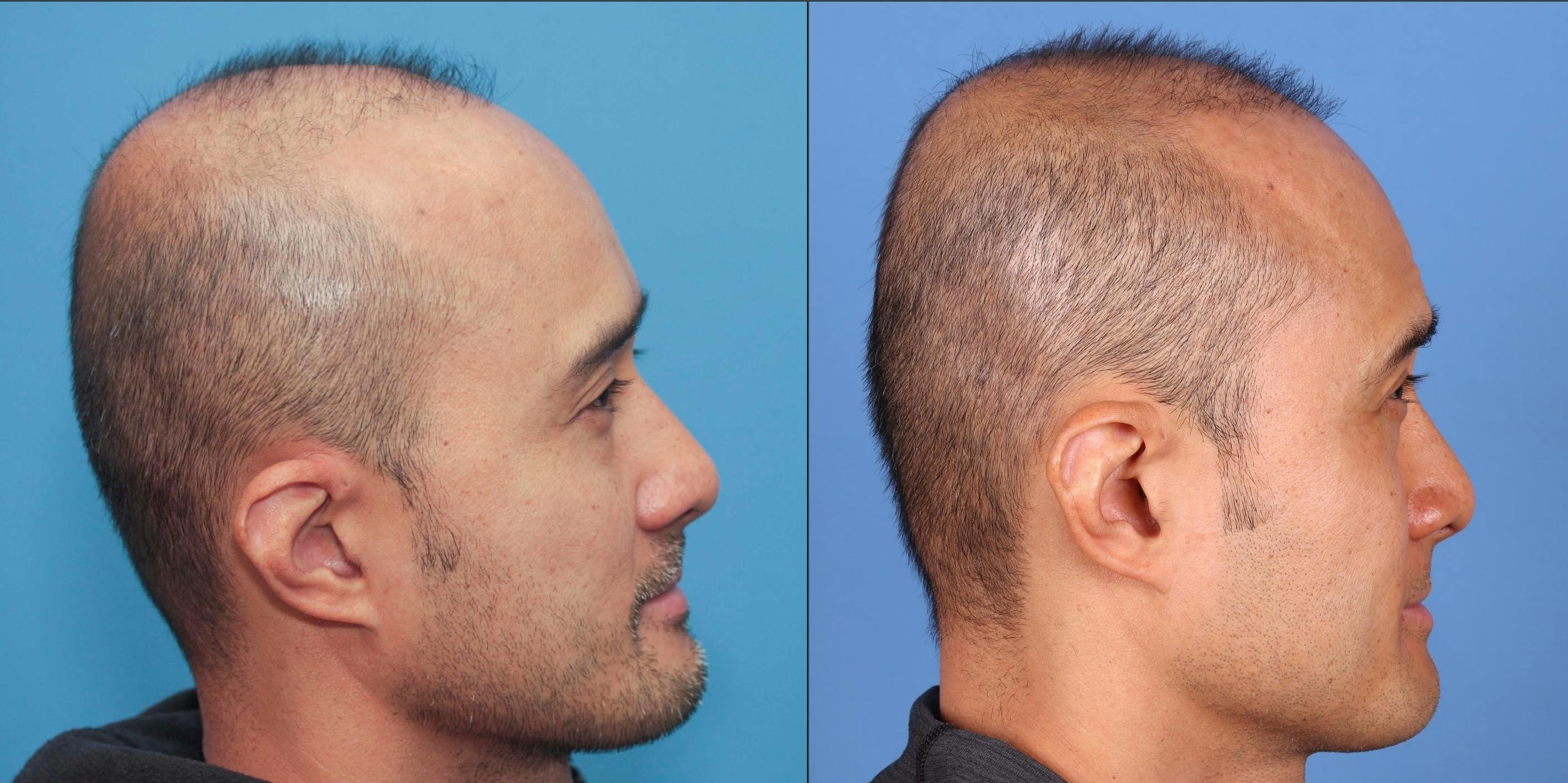 NeoGraft Hair Restoration Before & After Gallery - Patient 119927280 - Image 8