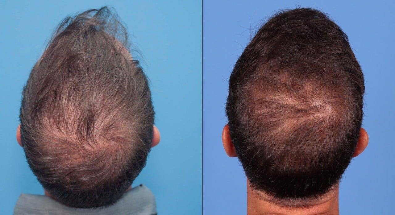 NeoGraft Hair Restoration Before & After Gallery - Patient 119927465 - Image 2