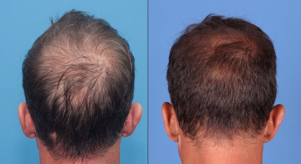 NeoGraft Hair Restoration Before & After Gallery - Patient 119927465 - Image 3