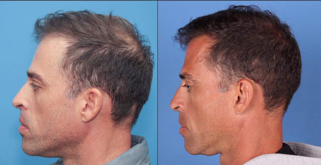 NeoGraft Hair Restoration Before & After Gallery - Patient 119927465 - Image 4
