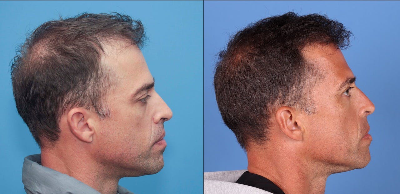 NeoGraft Hair Restoration Before & After Gallery - Patient 119927465 - Image 5