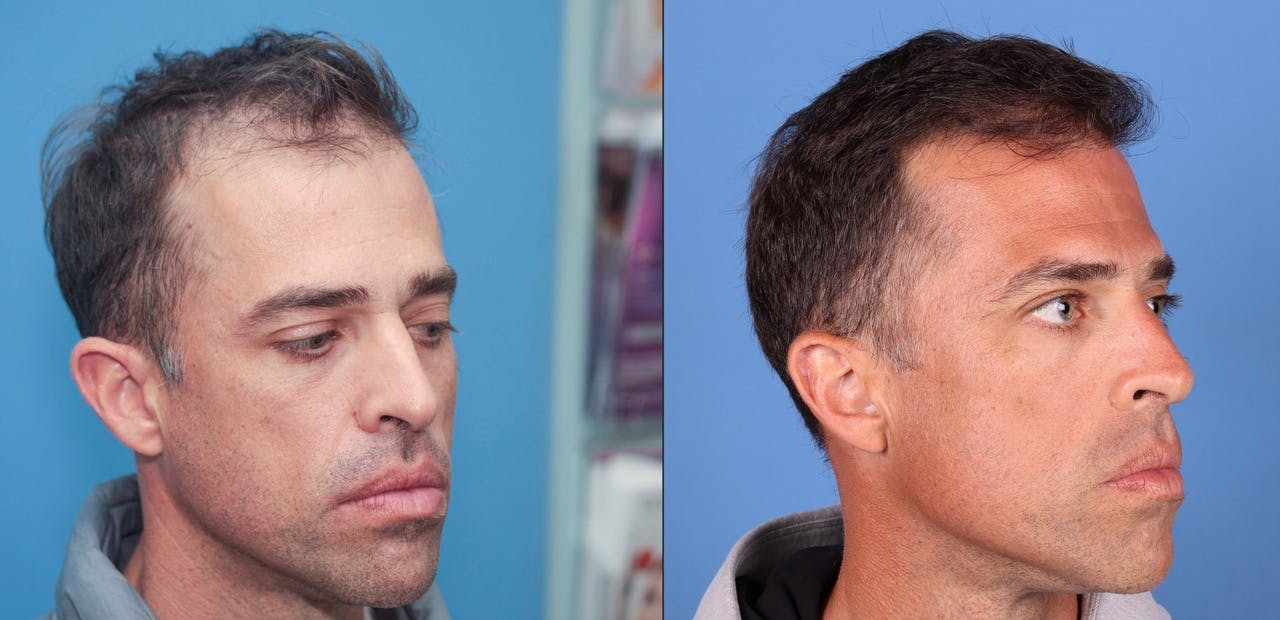 NeoGraft Hair Restoration Before & After Gallery - Patient 119927465 - Image 6