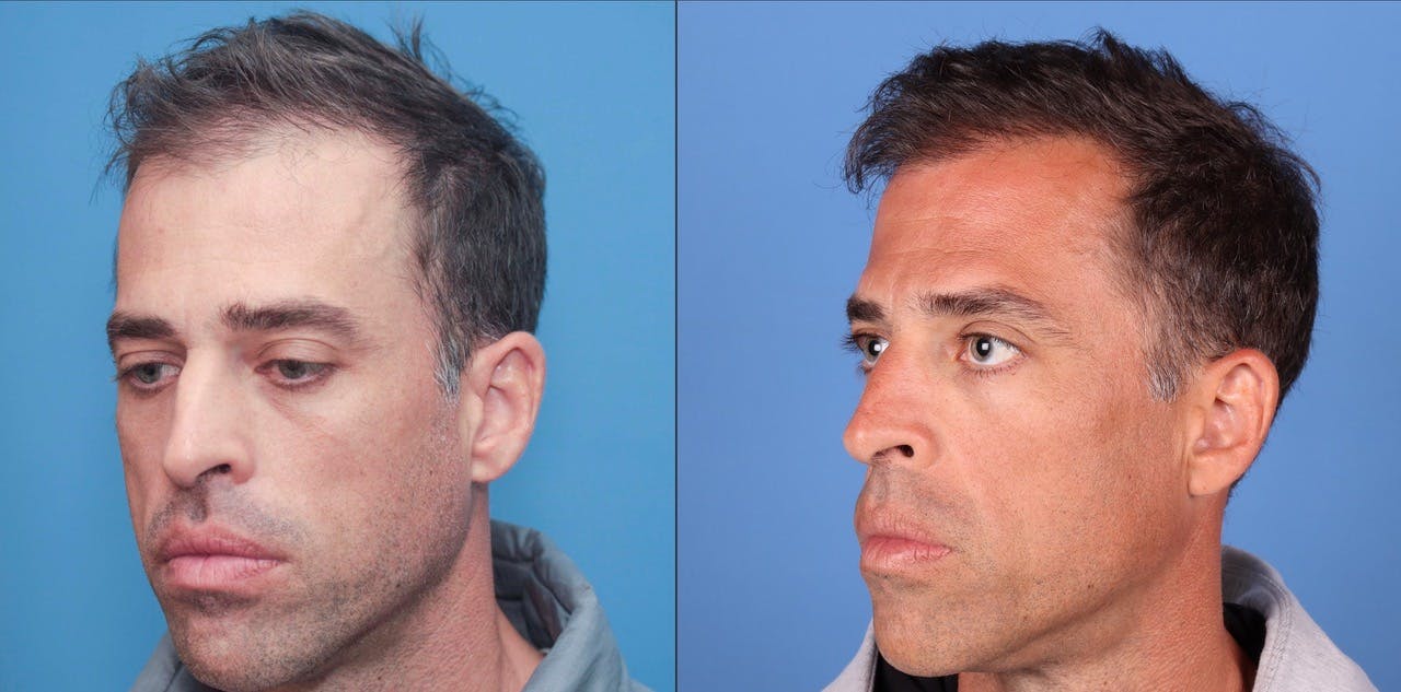 NeoGraft Hair Restoration Before & After Gallery - Patient 119927465 - Image 1