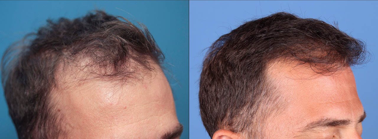 NeoGraft Hair Restoration Before & After Gallery - Patient 119927465 - Image 7