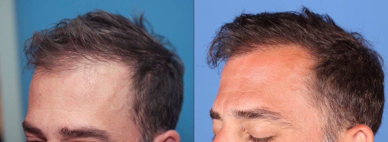 NeoGraft Hair Restoration Before & After Gallery - Patient 119927465 - Image 8