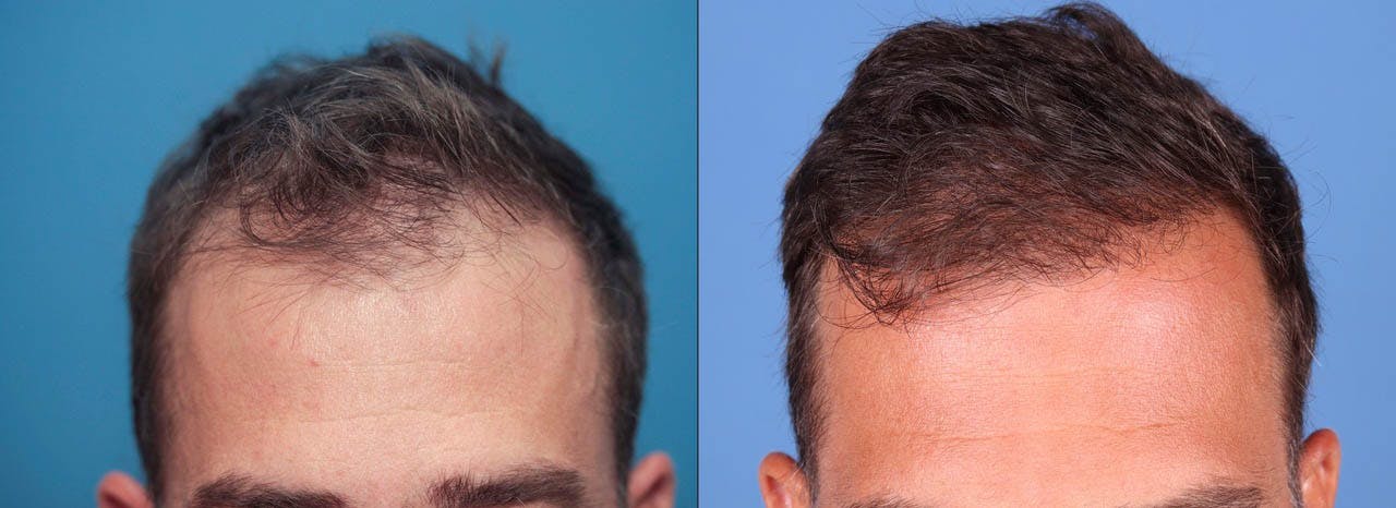 NeoGraft Hair Restoration Before & After Gallery - Patient 119927465 - Image 9