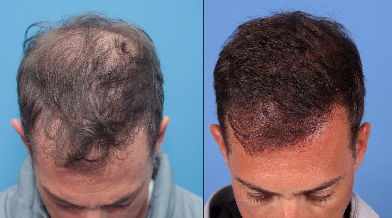 NeoGraft Hair Restoration Before & After Gallery - Patient 119927465 - Image 10