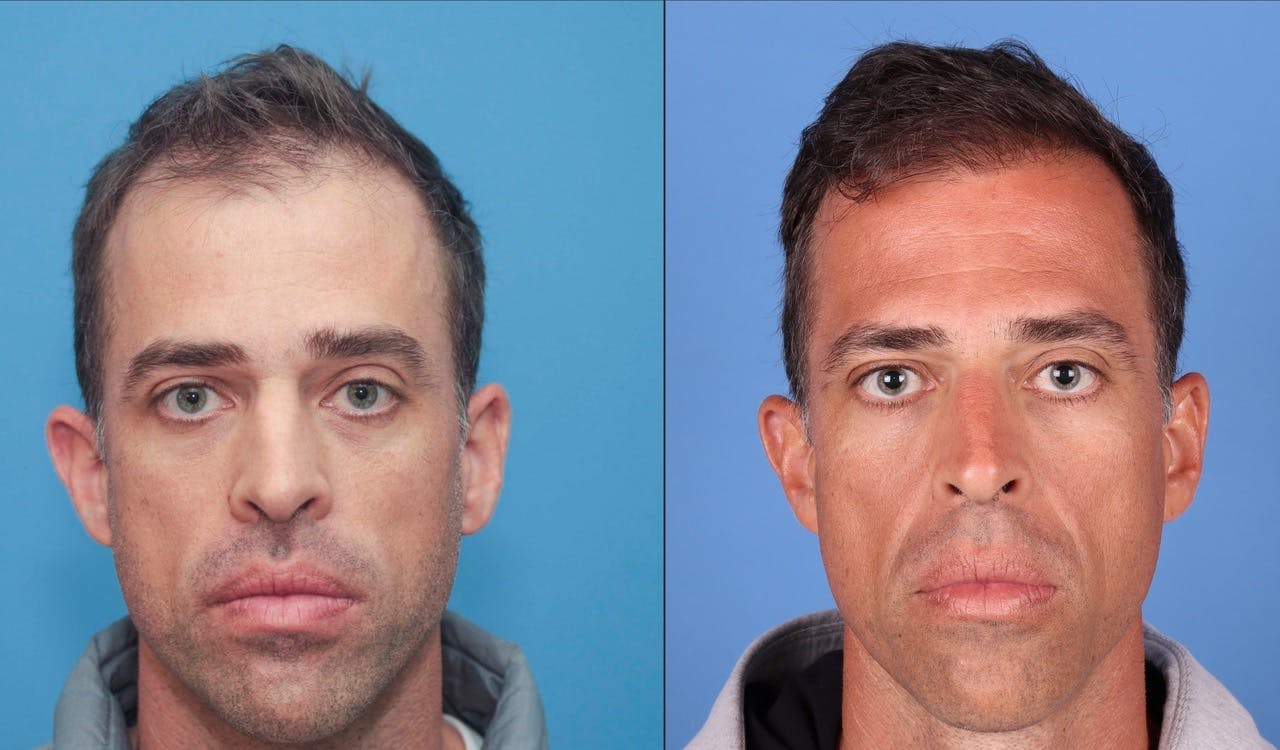 NeoGraft Hair Restoration Before & After Gallery - Patient 119927465 - Image 11