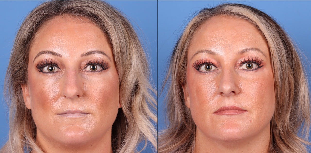 Rhinoplasty Before & After Gallery - Patient 119927497 - Image 3