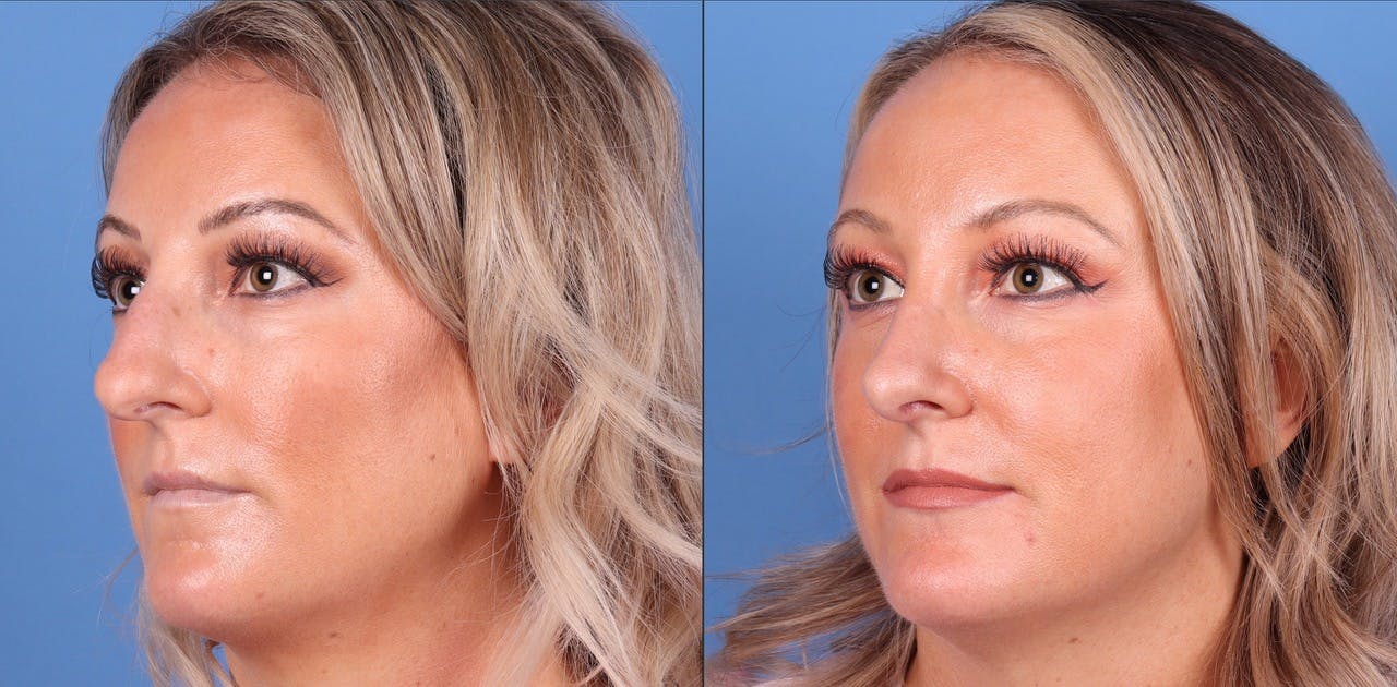 Rhinoplasty Before & After Gallery - Patient 119927497 - Image 2