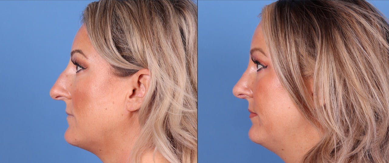 Rhinoplasty Before & After Gallery - Patient 119927497 - Image 1