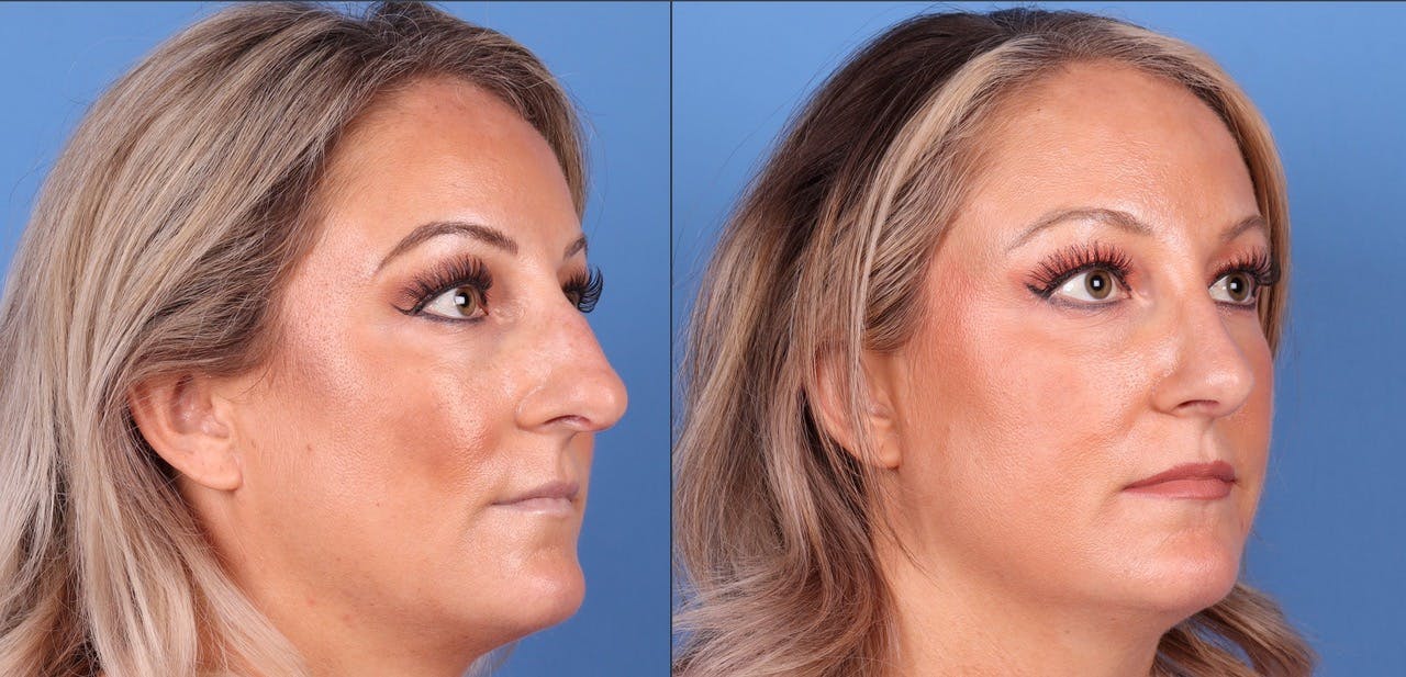 Rhinoplasty Before & After Gallery - Patient 119927497 - Image 4