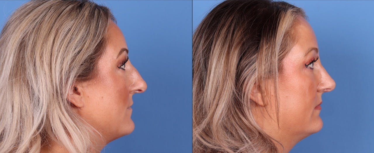 Rhinoplasty Before & After Gallery - Patient 119927497 - Image 5