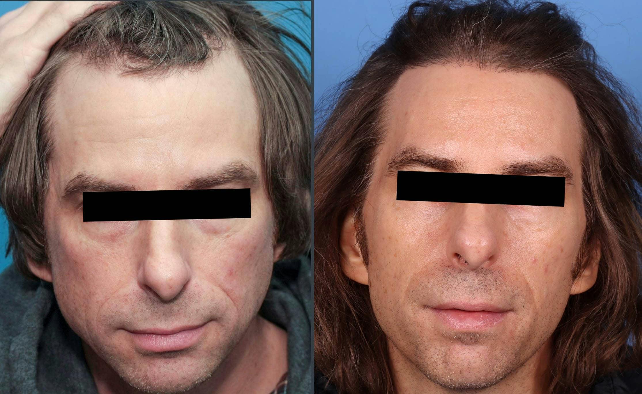 NeoGraft Hair Restoration Before & After Gallery - Patient 120352722 - Image 1