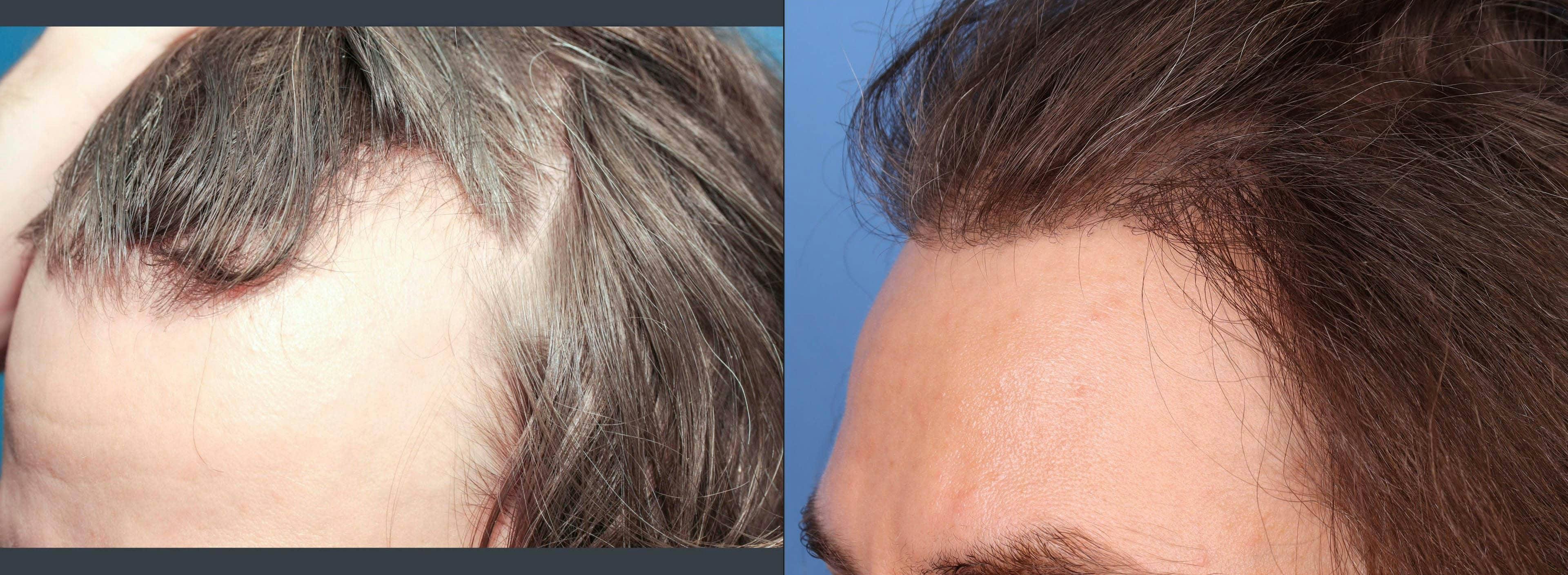 NeoGraft Hair Restoration Before & After Gallery - Patient 120352722 - Image 2