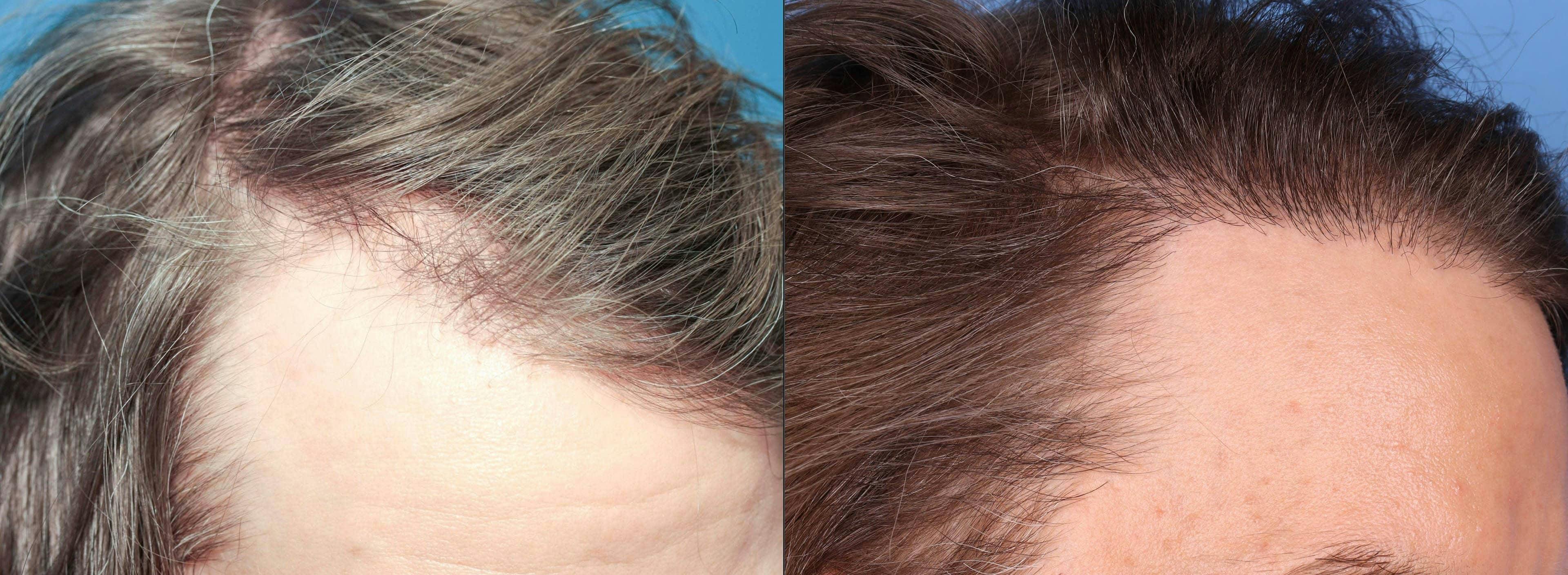 NeoGraft Hair Restoration Before & After Gallery - Patient 120352722 - Image 3