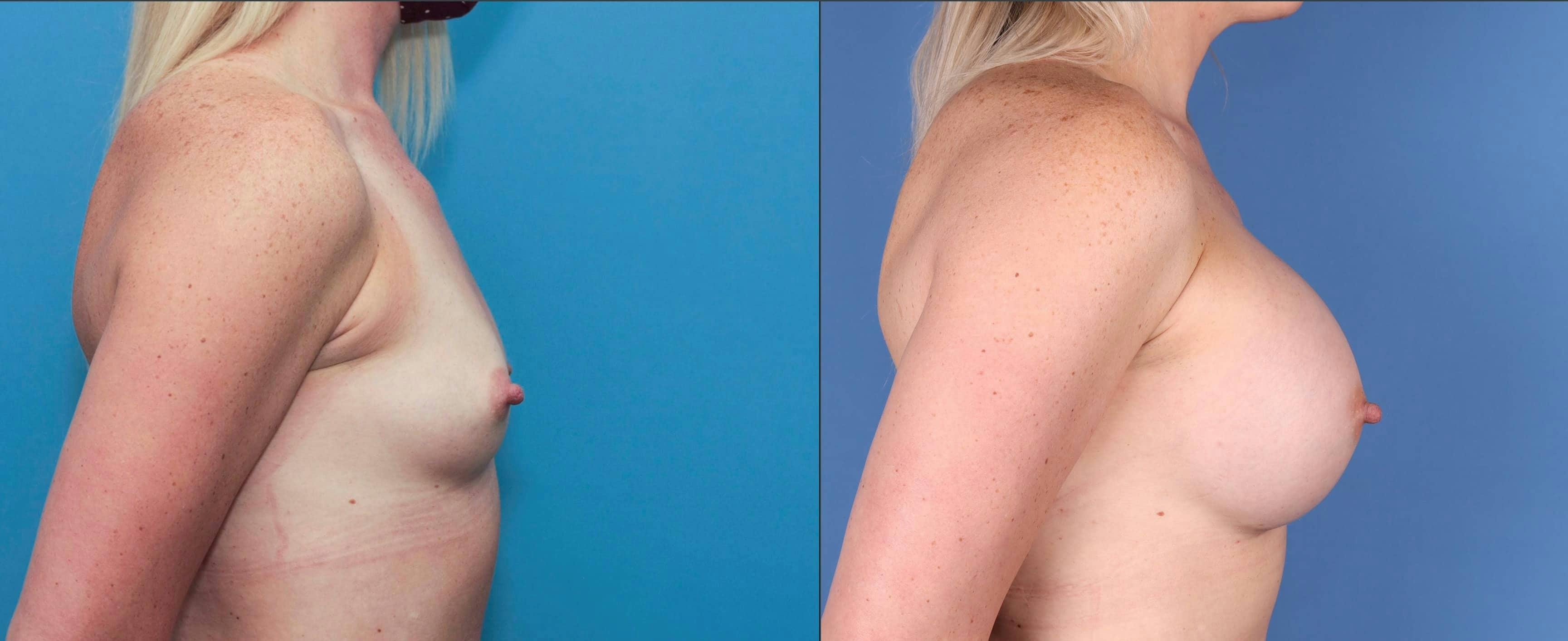 Breast Augmentation Before & After Gallery - Patient 120940806 - Image 3
