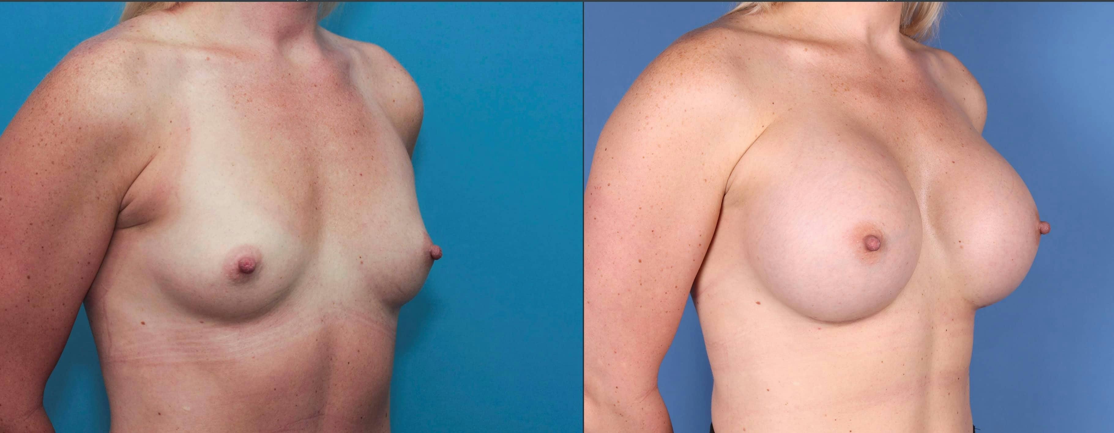 Breast Augmentation Before & After Gallery - Patient 120940806 - Image 2