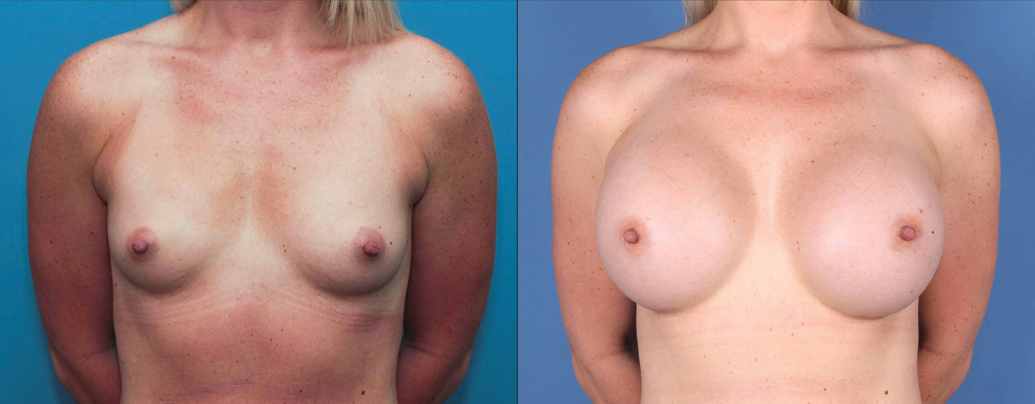 Breast Augmentation Before & After Gallery - Patient 120940806 - Image 1