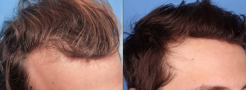 NeoGraft Hair Restoration Before & After Gallery - Patient 120941673 - Image 3