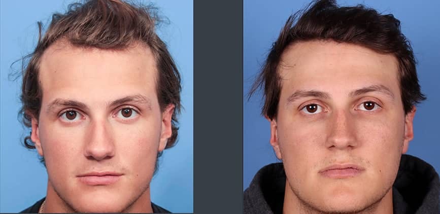 NeoGraft Hair Restoration Before & After Gallery - Patient 120941673 - Image 1