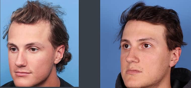 NeoGraft Hair Restoration Before & After Gallery - Patient 120941673 - Image 2