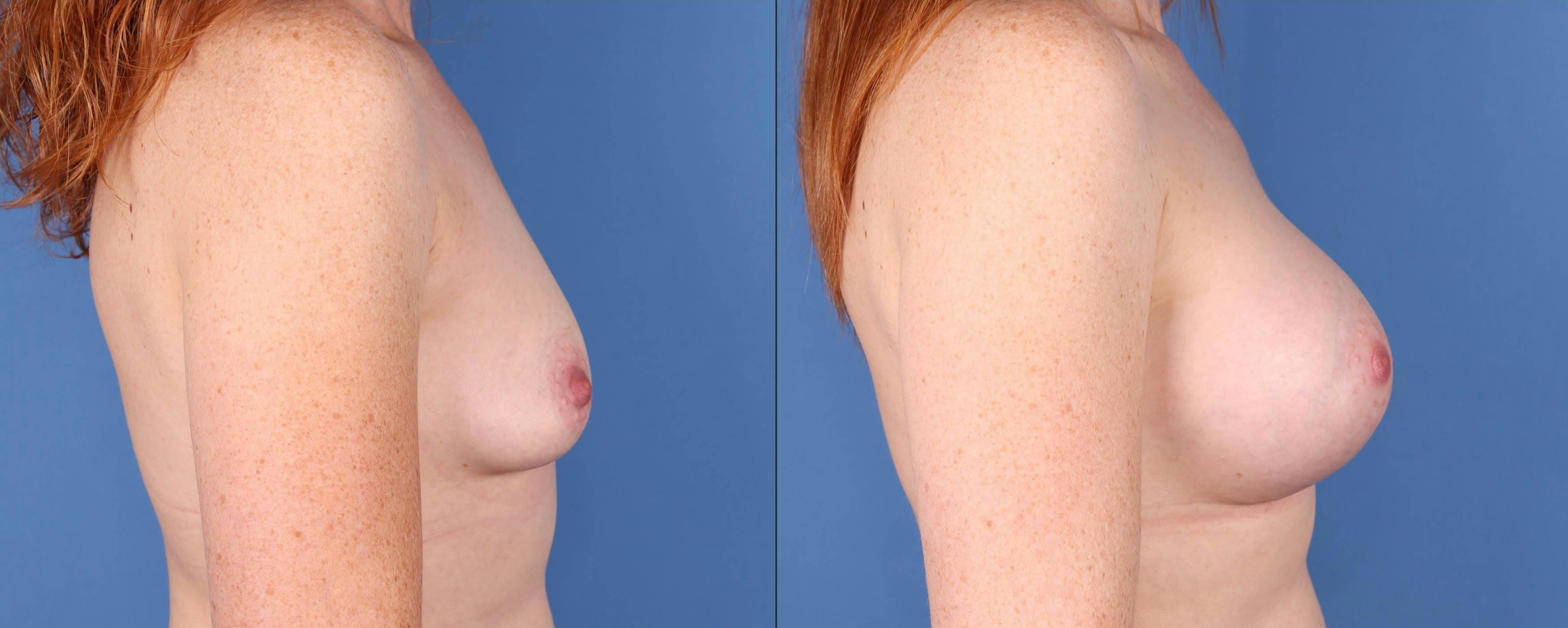 Breast Augmentation Before & After Gallery - Patient 121118170 - Image 3