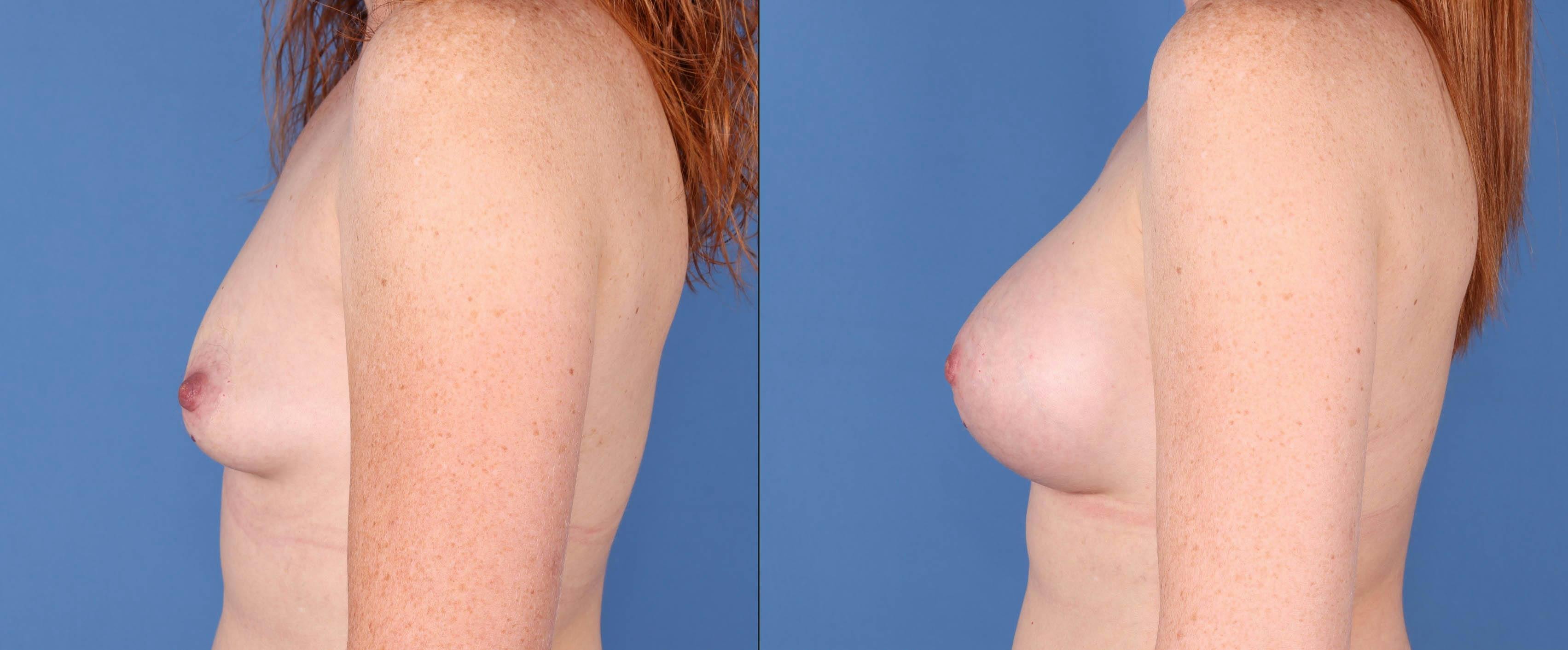 Breast Augmentation Before & After Gallery - Patient 121118170 - Image 5