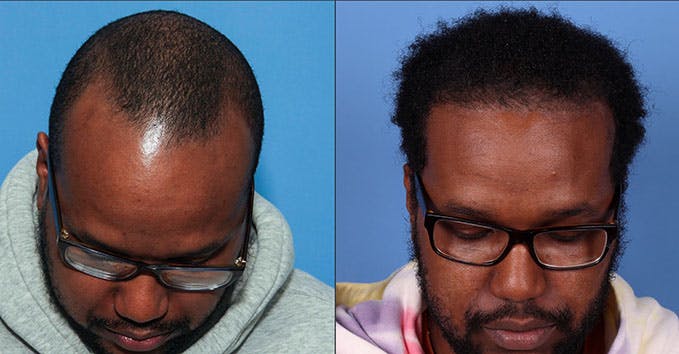 NeoGraft Hair Restoration Before & After Gallery - Patient 121124093 - Image 2